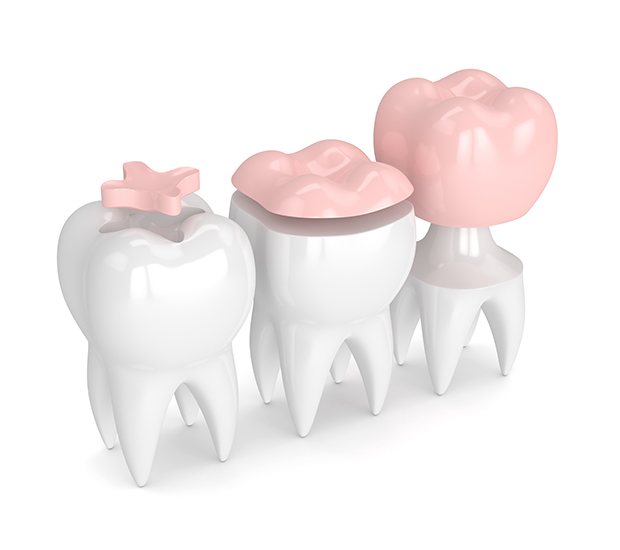 Morrisville Dental Inlays and Onlays